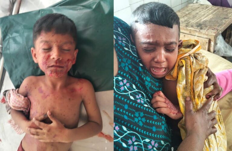 যশোর পরিত্যক্ত বোমা বিস্ফোরণে দুই শিশু আহত